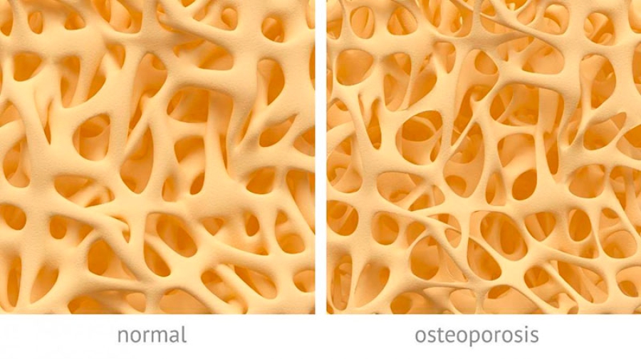 Moralzarzal | Taller gratuito: ¿Cómo prevenir la osteoporosis?